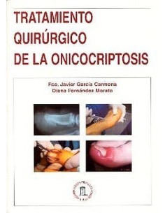 Tratamiento Quirurgico de la Onicocriptosis