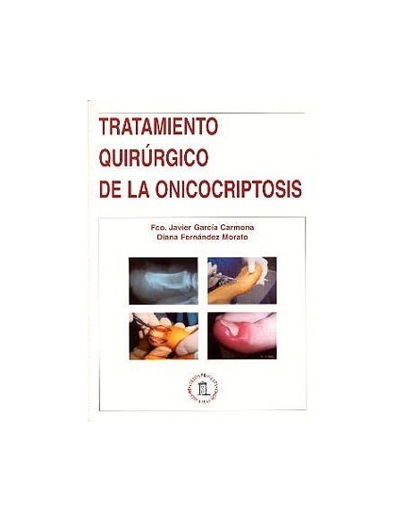 Tratamiento Quirurgico de la Onicocriptosis