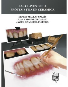 Las Claves de la Protesis fija en Cerámica