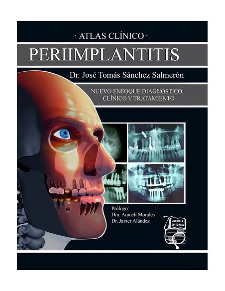 Atlas Clínico de Periimplantitis "Nuevo Enfoque Diagnóstico Clínico y Tratamiento"