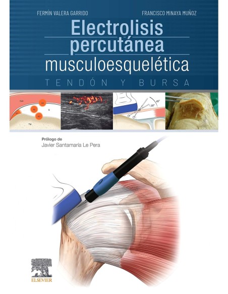 Electrolisis percutánea musculoesquelética. Tendón y bursa