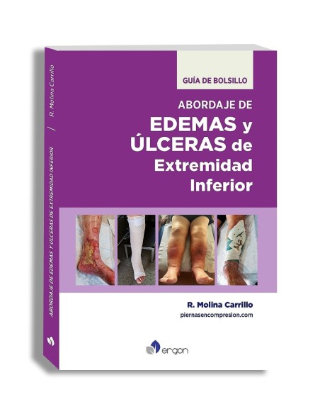 Guía de Bolsillo Abordaje de Edemas y Úlceras de Extremidad Inferior