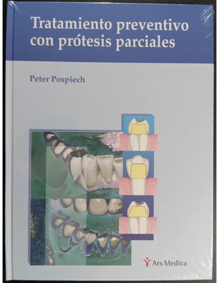Tratamiento preventivo con prótesis parciales