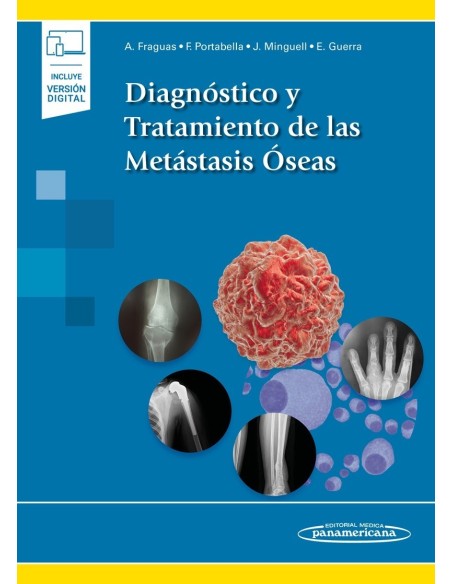 Diagnóstico y Tratamiento de las Metástasis Óseas (incluye versión digital)