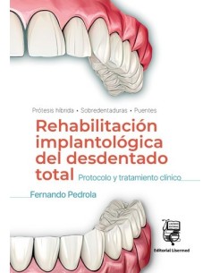 Rehabilitación Implantológica del desdentado total: Protocolo y tratamiento clínico