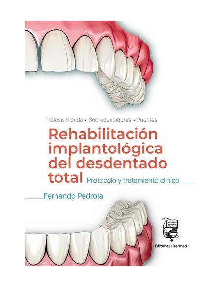 Rehabilitación Implantológica del desdentado total: Protocolo y tratamiento clínico