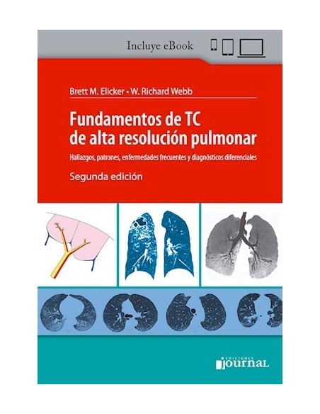 Fundamentos de TC de Alta Resolución Pulmonar. Hallazgos